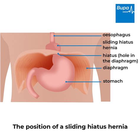 Hiatus Hernia Types, Causes, Symptoms, Complications,, 48% OFF