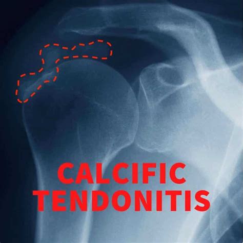 Calcific Tendonitis - Causes, Symptoms & Treatment