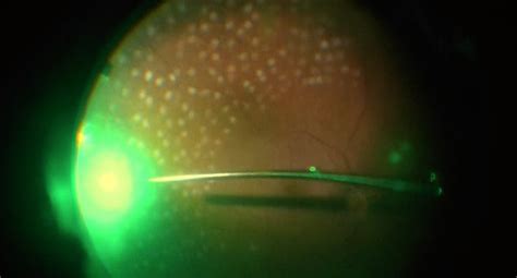 Endolaser Panretinal Photocoagulation (PRP) - Wills Eye Library