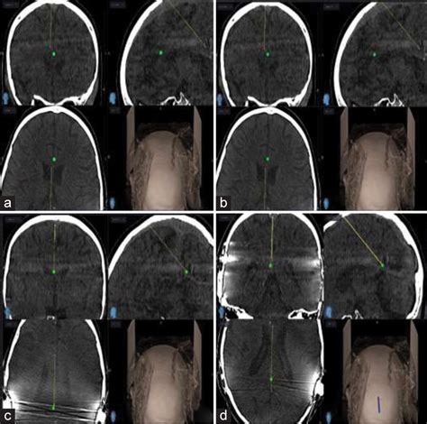 Surgical Neurology International