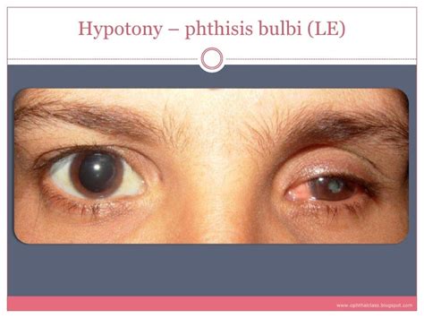 Sequelae & Complications of Uveitis