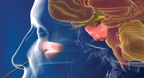 Endoscopic Endonasal Approach for pituitary tumors - Dr. Maroon