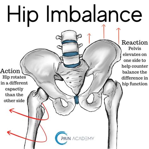 Pin on Hip Hip Horray - FAI & Recovery