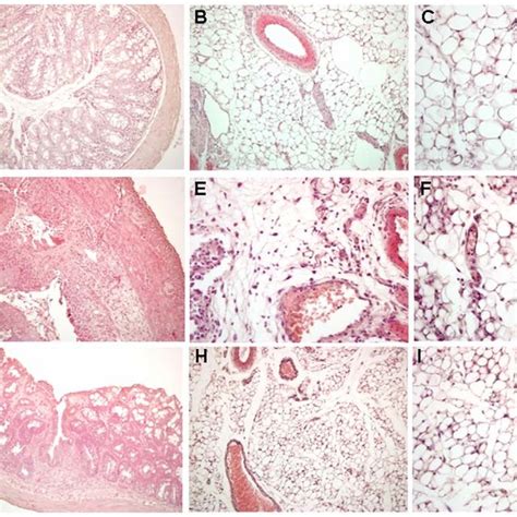 Distinctive histologic features the creeping fat and mesenteric adipose ...