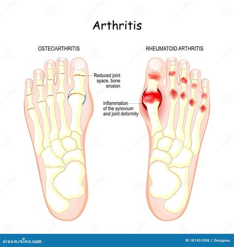 Osteoarthritis, Rheumatoid Arthritis, and Posttraumatic Arthritis Stock ...