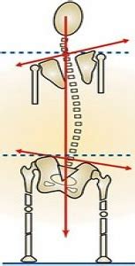 Leg Length Discrepancy - Manchester-Bedford Myoskeletal LLC