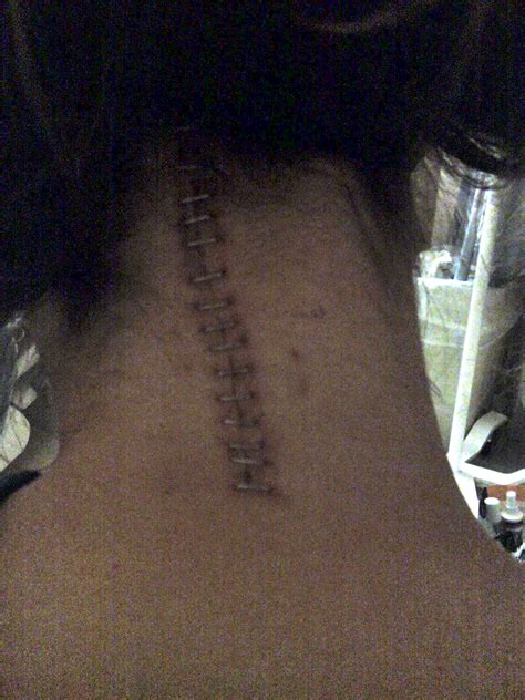 It Isn't Brain Surgery: Scars Make You A Badass