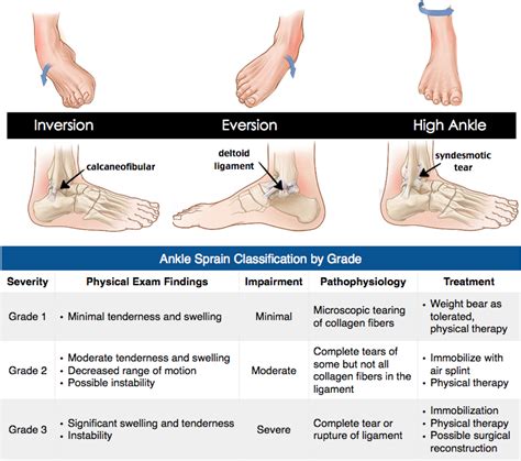 Rosh Review | Sprained ankle, Ankle fracture, Ankle sprain grades