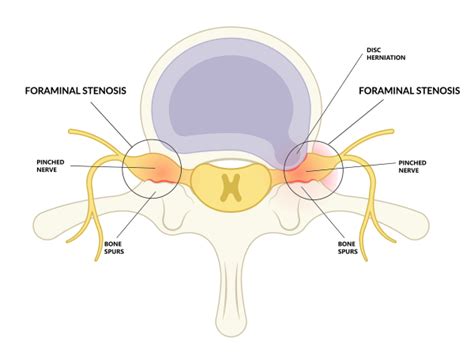 Bilateral Foraminal Stenosis | Causes, Symptoms & Treatment