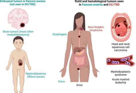 Frontiers | Fanconi anemia and dyskeratosis congenita/telomere biology disorders: Two inherited ...