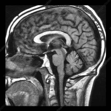 Wernicke's Encephalopathy on MRI - Stock Image - C043/0256 - Science ...