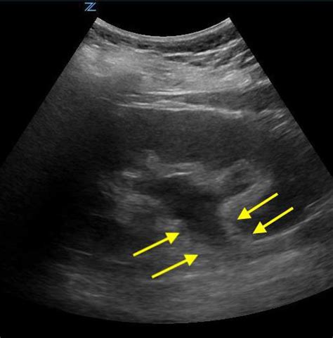 Renal Ultrasound | Sonoguide