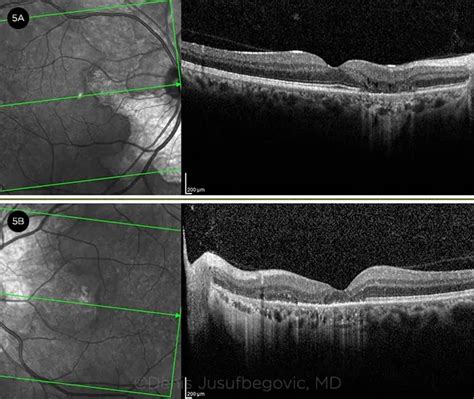 Diagnosis and Management of Serpiginous Choroiditis - American Academy of Ophthalmology