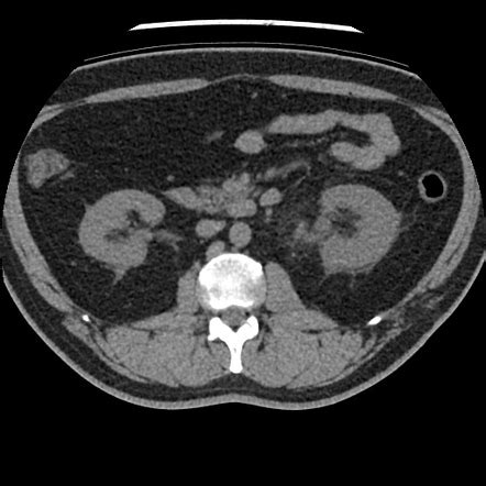 Perinephric stranding | Radiology Reference Article | Radiopaedia.org