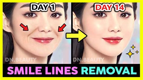 Latest SMILE LINES (LAUGH LINES) REMOVAL AND FILL WITH KOREAN FACE EXERCISE & MASSAGE IN 2 WEEKS ...