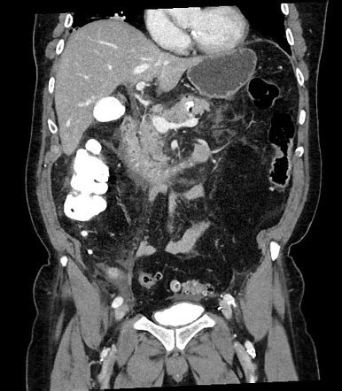 Pancreatitis | Radiology Reference Article | Radiopaedia.org