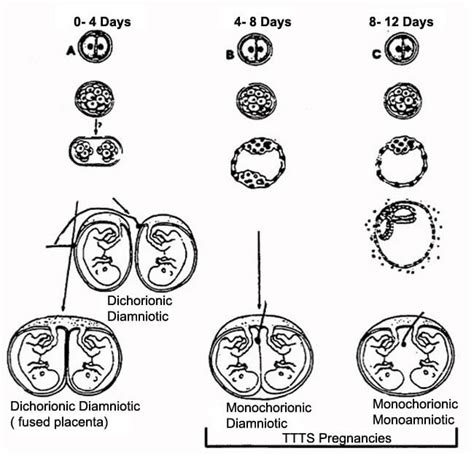 The Monochorionic Twin Placenta | TTTS Foundation