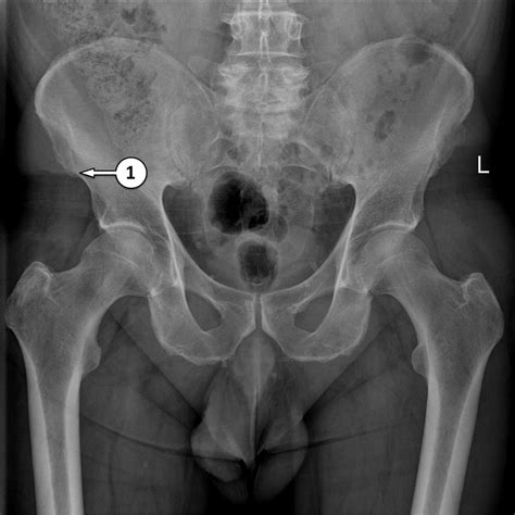 [DIAGRAM] X Ray Pelvis Diagram - MYDIAGRAM.ONLINE