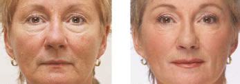 Facial Exercises Produce Gorgeous Natural Facelifts For Men And Women ...