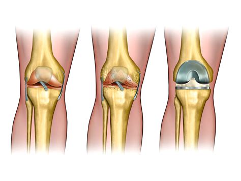 Tips for a Successful Knee Replacement Recovery - PKLPT - Bethpage ...