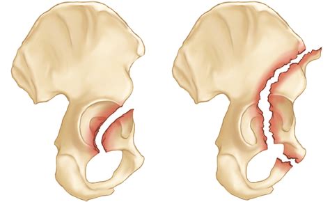 Acetabular Fractures - OrthoInfo - AAOS