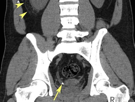 RiT radiology: Helical CT for Urolithiasis