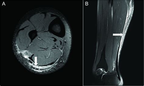 Connective tissue injury in calf muscle tears and return to play: MRI correlation | British ...