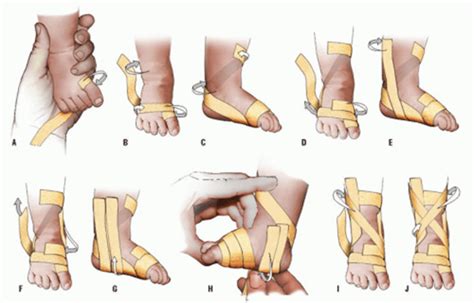 Club Foot(Congenital talipes equinovarus) - The Nepali Doctor