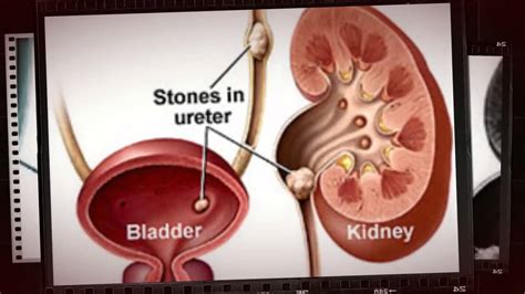 renal calculi symptoms and causes - YouTube