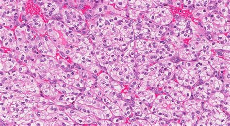 Clear cell renal cell carcinoma | Ottawa Atlas of Pathology