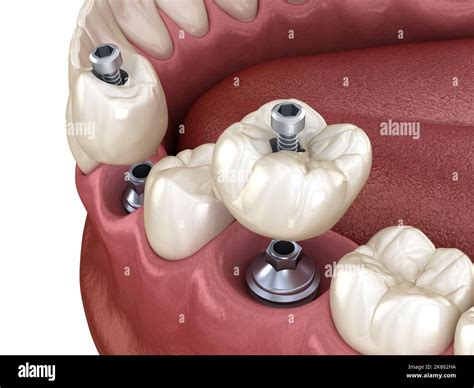 Premolar and Molar tooth crown installation over implant, screw fixation. 3D illustration of ...