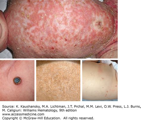 Inflammatory and Malignant Histiocytosis | Oncohema Key