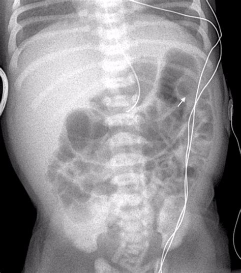 Neonatal small left colon syndrome (NSLCS): Rare but important ...