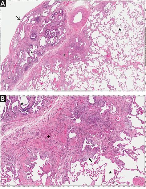 Interstitial Lung Disease Histology