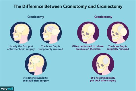 La différence entre la craniotomie et la craniectomie