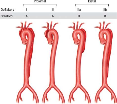 Med4yu: Aortic Dissection