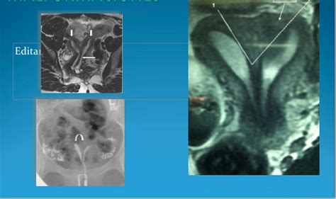 How to diagnose the uterine septum in a noninvasive way? | ResearchGate