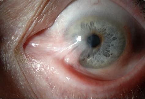 Chalazion Surgery | Pterygium (Surfer's Eye) | Pinterest