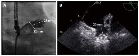 Percutaneous left atrial appendage closure: Technical aspects and prevention of periprocedural ...