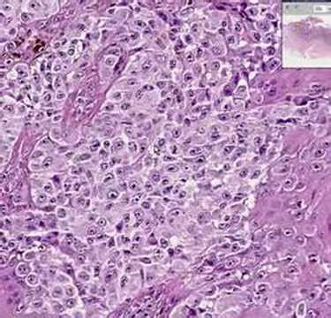 Malignant Melanoma Histology