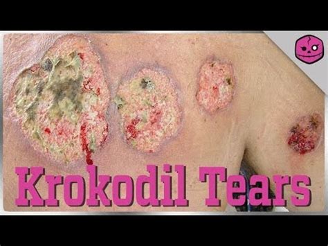 Krokodil Drug Rots The Skin