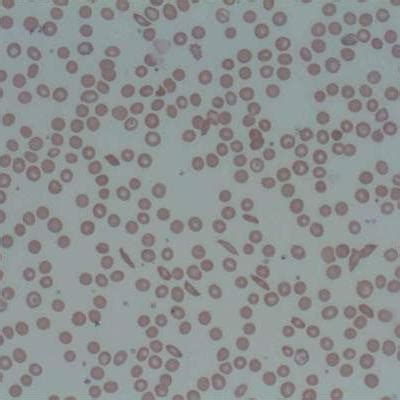 More than 75% with sickle cell crises don’t get hydroxyurea | MDedge Family Medicine