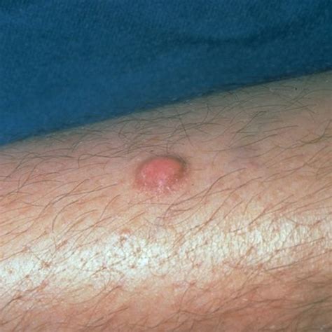 Hard Skin Nodule