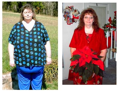 Before and After Lap Band Surgery - PICTURES ONLY - Weight Loss Surgery Success Stories ...