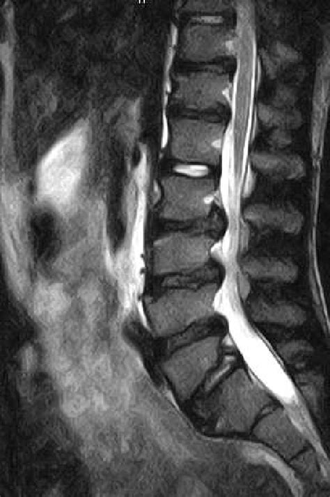 Intervertebral disc degeneration (IDD) and other ab- normalities... | Download Scientific Diagram