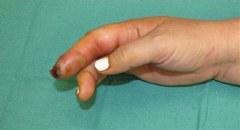 Finger infections (paronychia, felons, pyogenic flexor tenosynovitis) - Clinical Tree