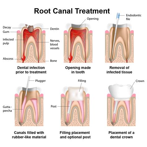 Root Canal Therapy – Albuquerque, NM – Parkway Dental - Dental Crown