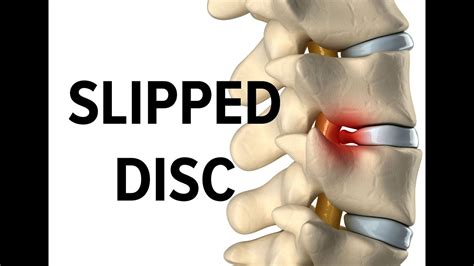 Slipped Disc Treatment in Singapore - YouTube