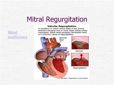 PPT - Intro to Valvular Disease PowerPoint Presentation, free download - ID:1468217