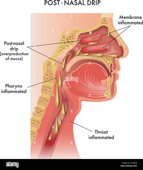 Upper airway cough syndrome hi-res stock photography and images - Alamy